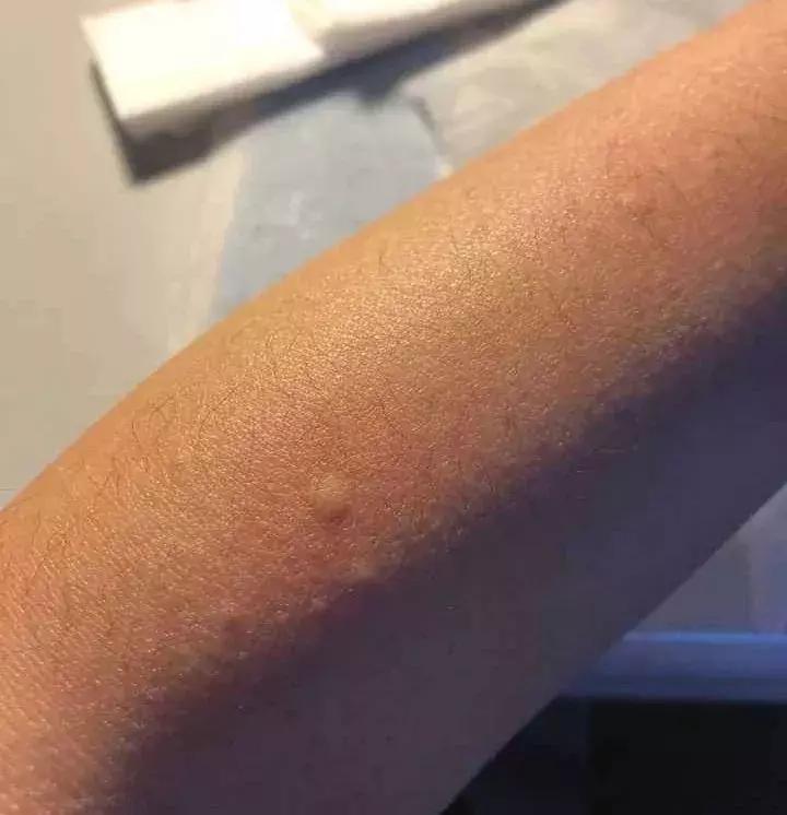 到底什么样的脱毛方法才比较靠谱,一到这个季节就脱毛