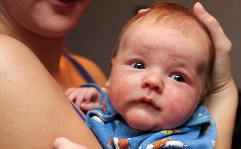 中医治疗长期反复湿疹,儿童反复的湿疹是怎么回事