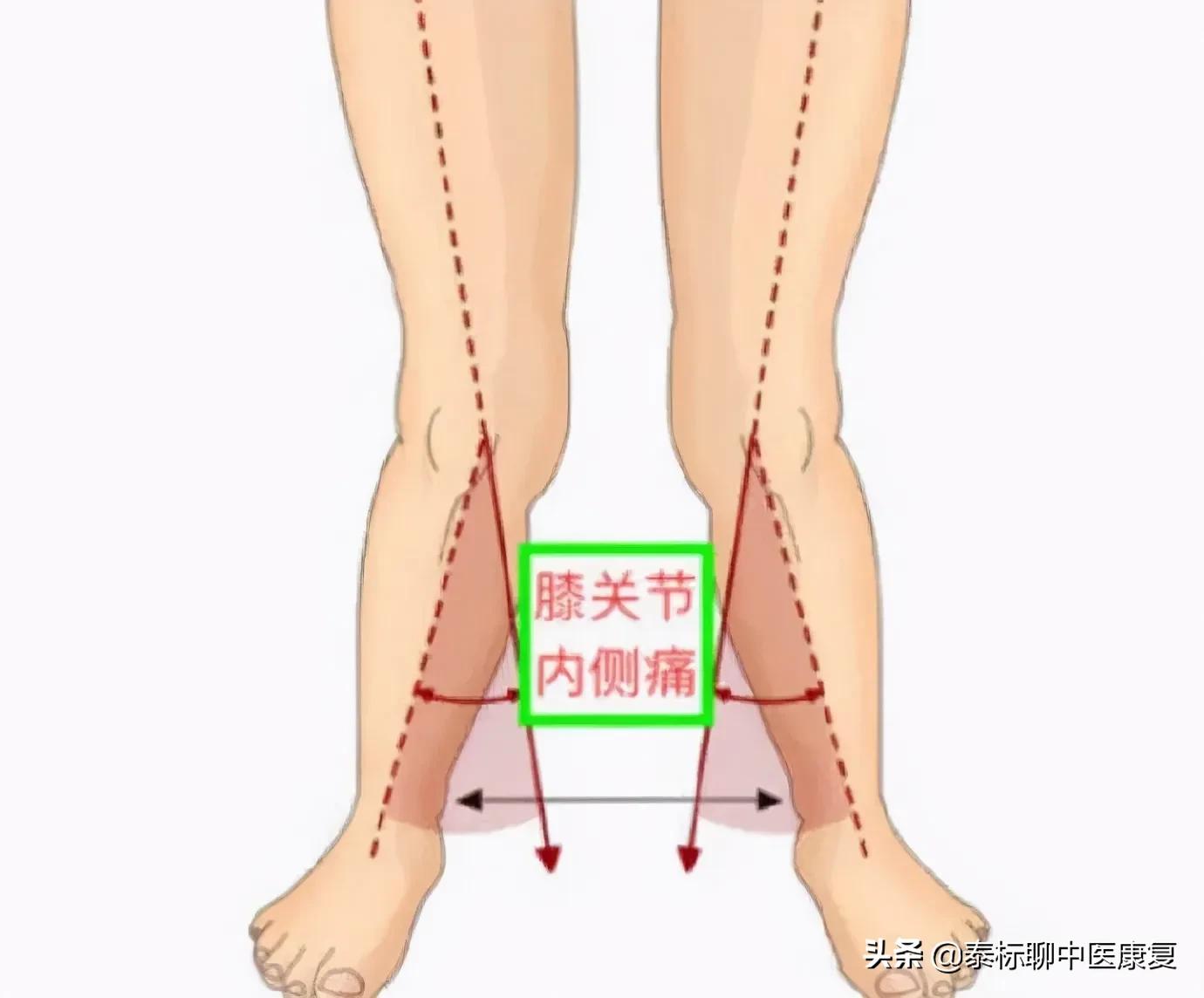 膝关节增生疼痛偏方,四神煎治膝关节疼痛