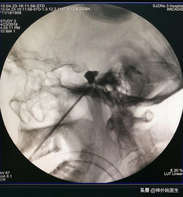 三叉神经痛微创治疗方法,超微创定向修复三叉神经