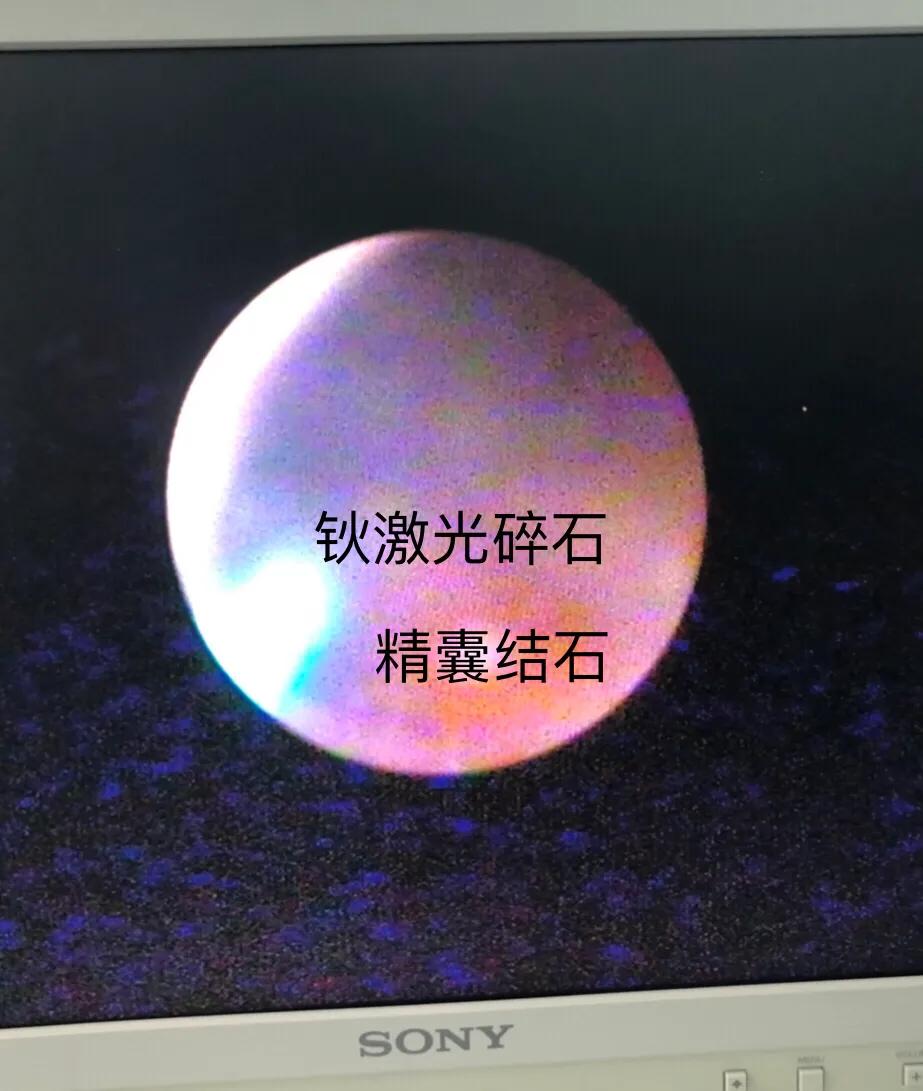 精囊结石精囊镜,精囊镜与钬激光手术