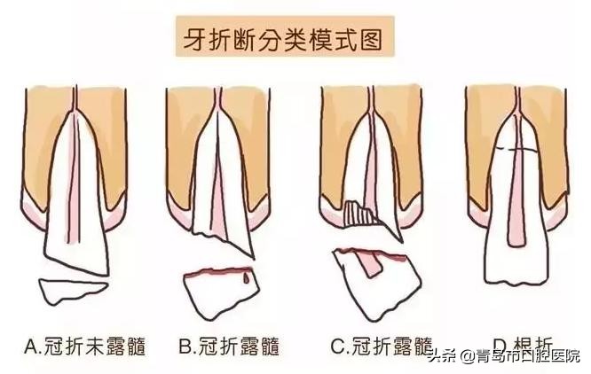 孩子摔断牙不要一扔了之,家长这么做可以让牙齿“起死回生”