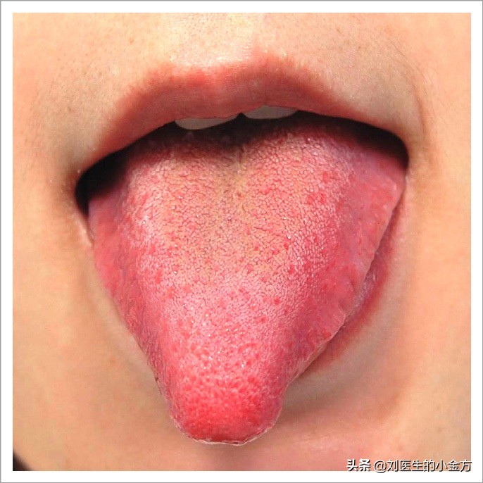 中医舌诊图解100例,中医舌诊图与舌诊口诀