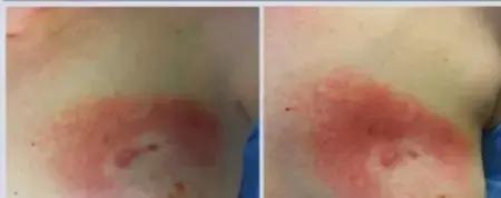 质子治疗适用于什么癌症,质子治疗癌症的疗效咋样