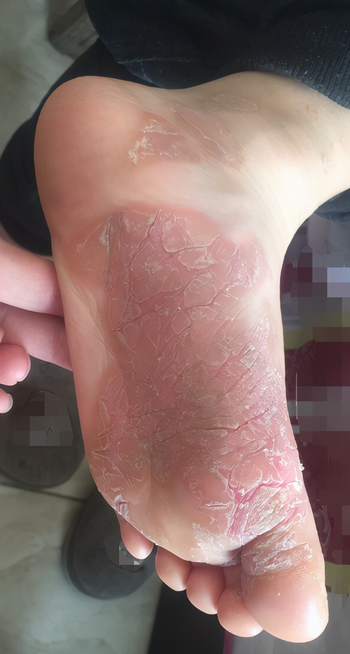 泡醋可以止足癣痒,但治标不治本