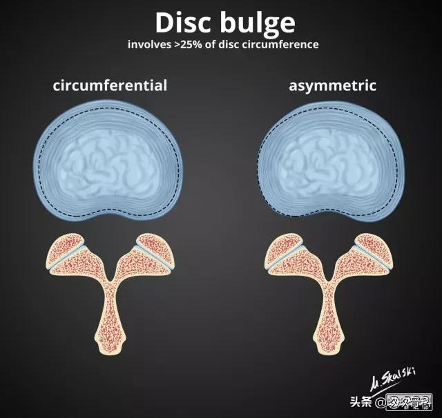 图解腰椎间盘突出,椎间盘髓核膨出图