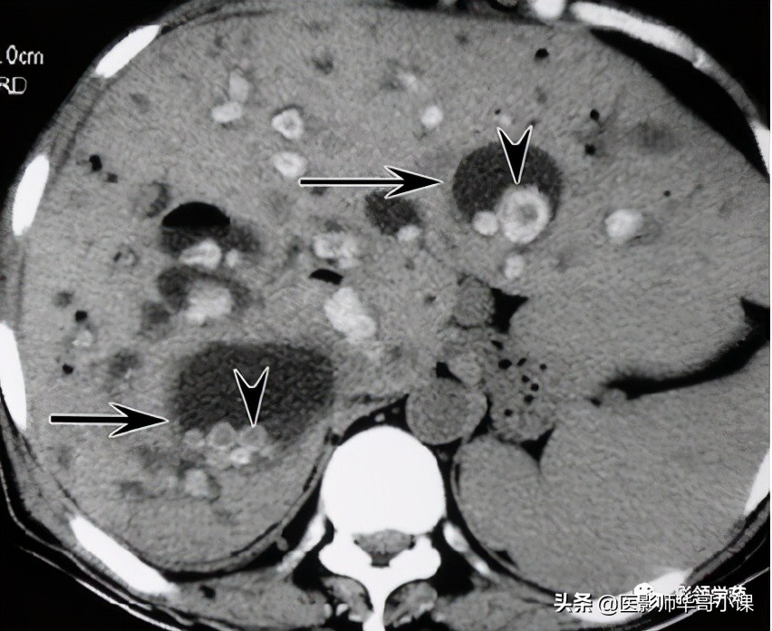 胆总管变异,胆胰管解剖