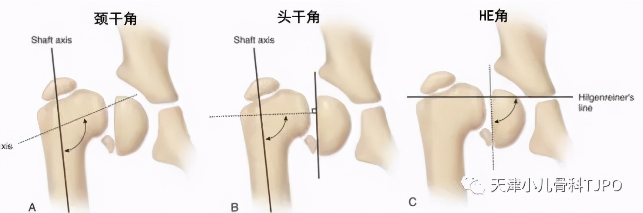 小儿先天性髋内翻名词解释,小孩走路颠足内翻