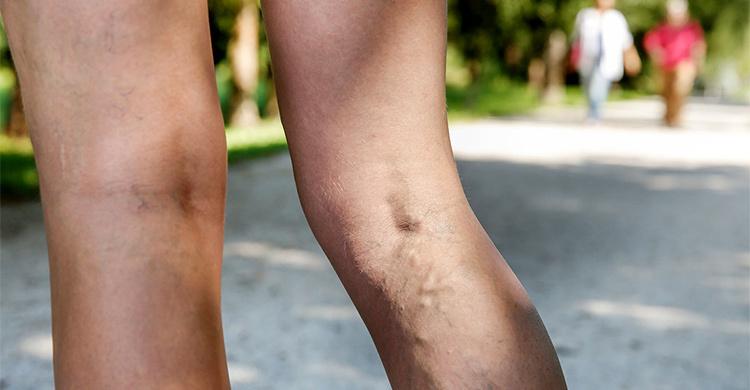 静脉曲张手术后引起血栓怎么回事,怀孕期间静脉曲张