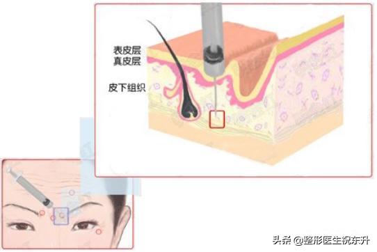 眉间除皱针的危害和副作用,除皱针祛额纹的危害和副作用