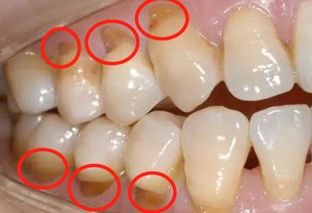 刷牙方式不对导致牙齿有条沟,错误的刷牙方式牙齿还能刷白嘛