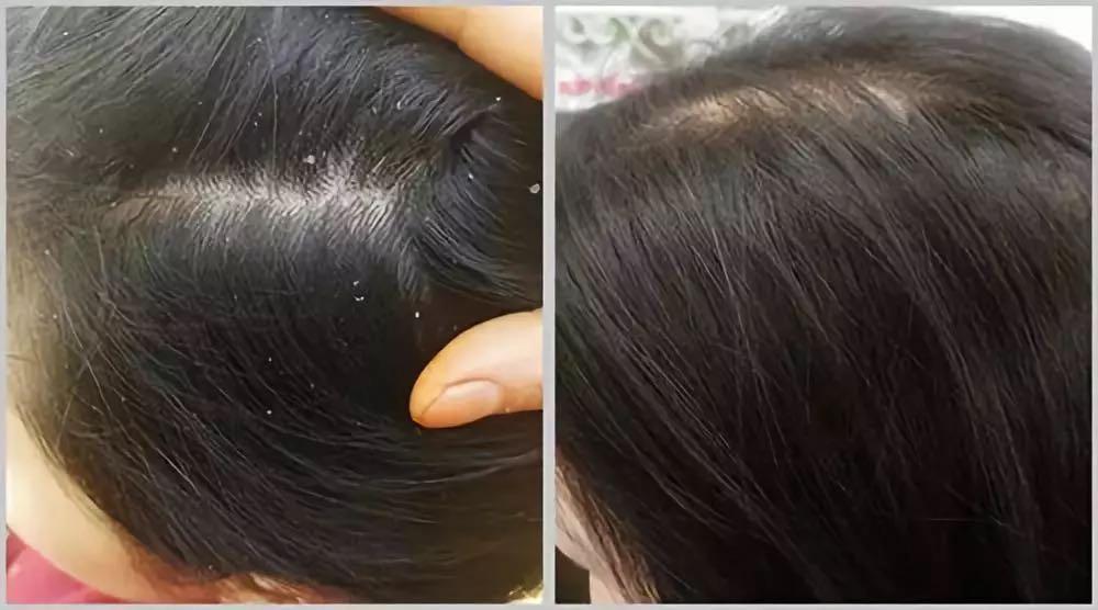 拉芳控油洗发水掉发,拉芳洗发水洗了掉发严重