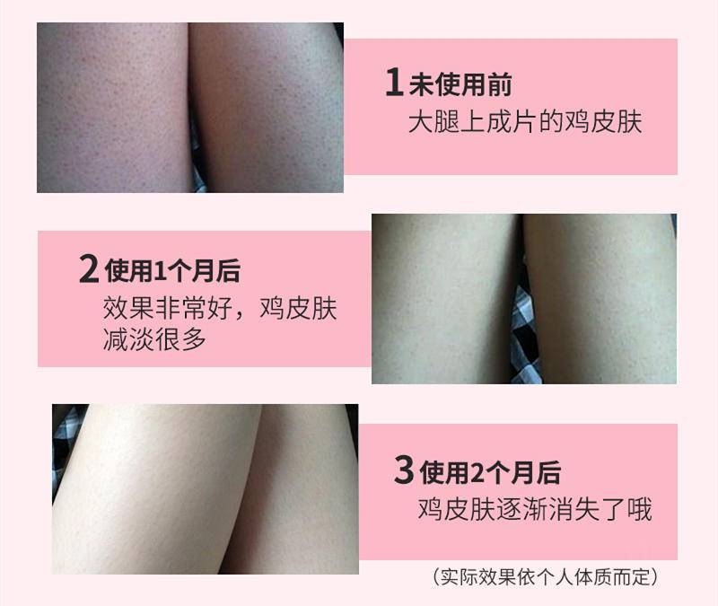关节去黑小妙招,怎么预防关节变黑