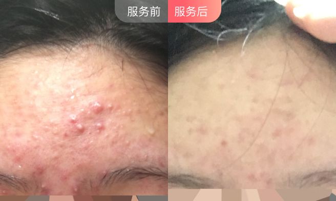 烂脸救星护肤品,烂脸急救修复面膜推荐