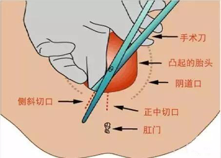 分娩妈妈害怕产痛,顺产被侧切怎样才好得快