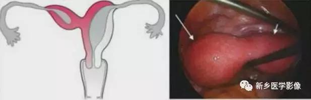 子宫发育异常,应想到的6大类常见畸形