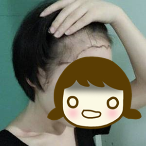 发际线太高怎么办,发际线太高怎么办做什么发型