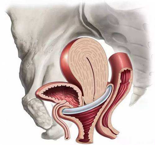 子宫脱垂做什么运动,子宫脱垂还能怀孕吗