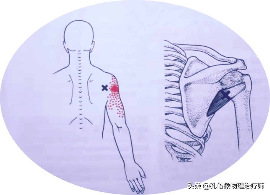 后背肩胛骨疼什么原因造成的,深呼吸造成右后背肩胛骨下方疼痛