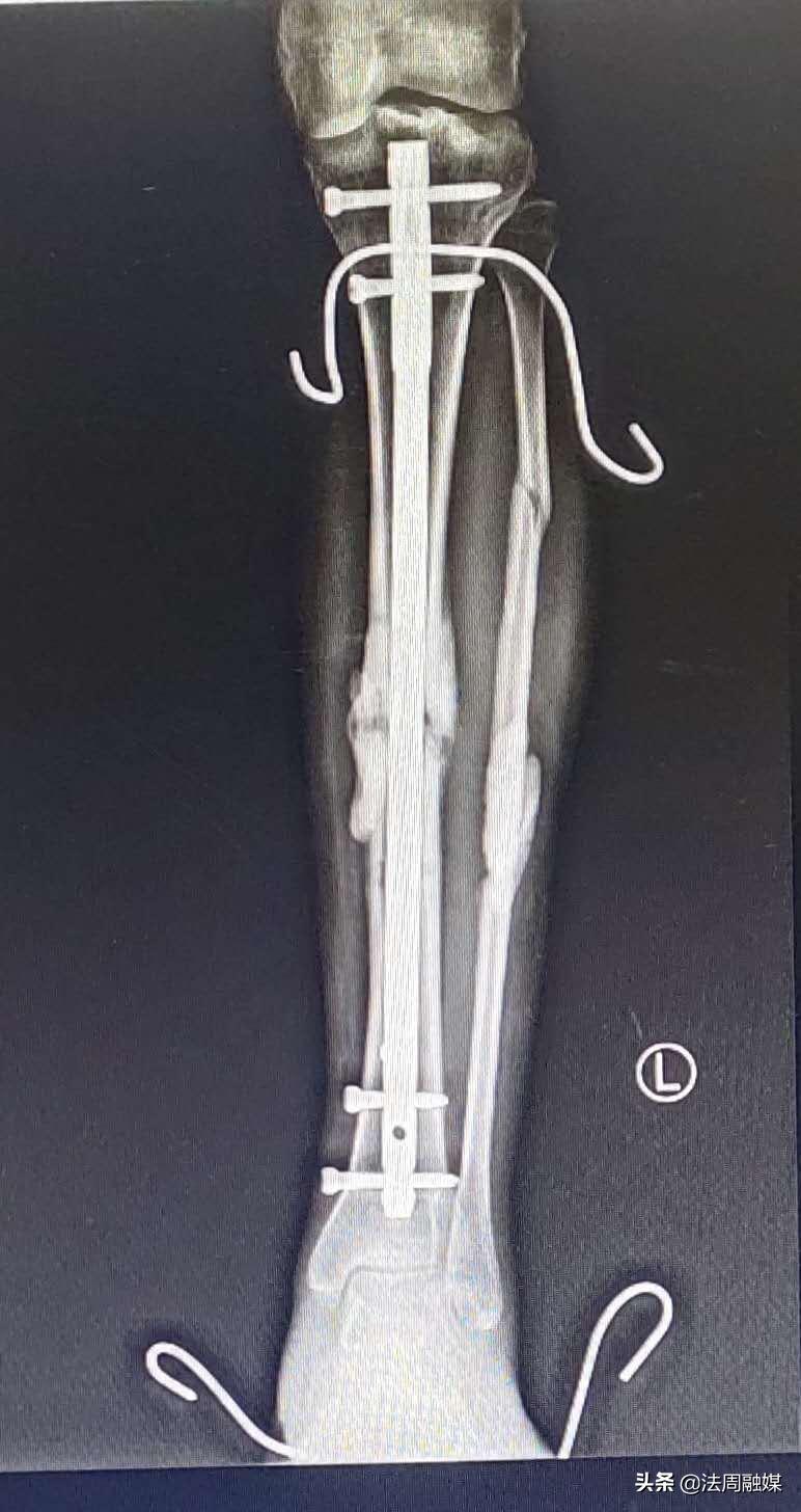 交通事故小腿胫骨骨折做手术,常德市第一中医医院骨伤科