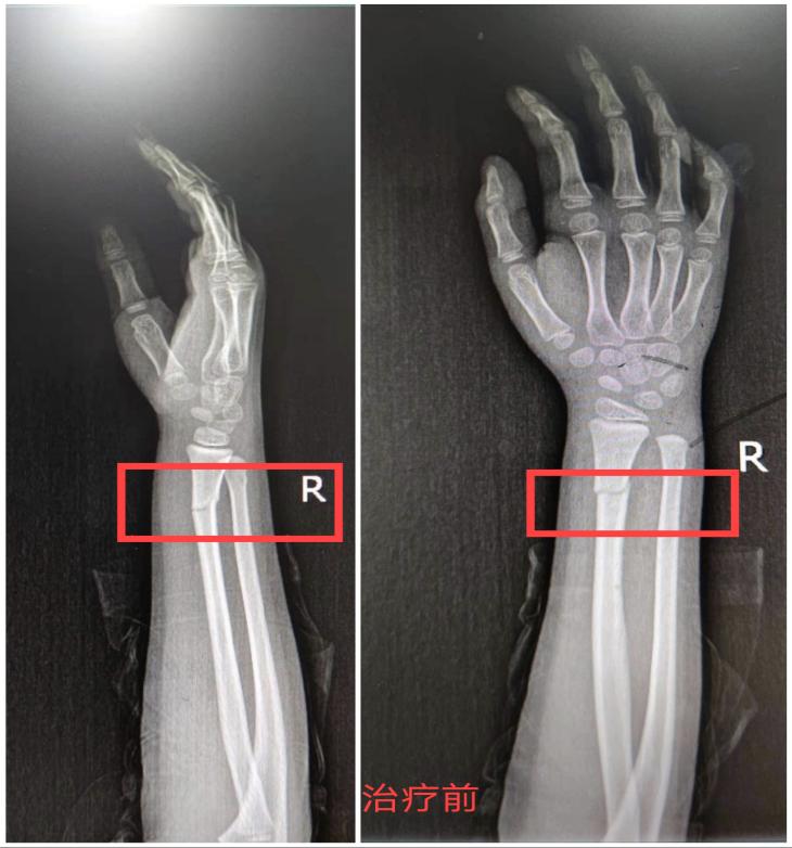 孩子意外骨折如何处理,3岁女童受伤医生建议报警
