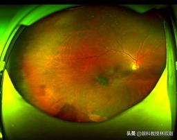 熬夜短时间眼底出血,眼底大出血失明