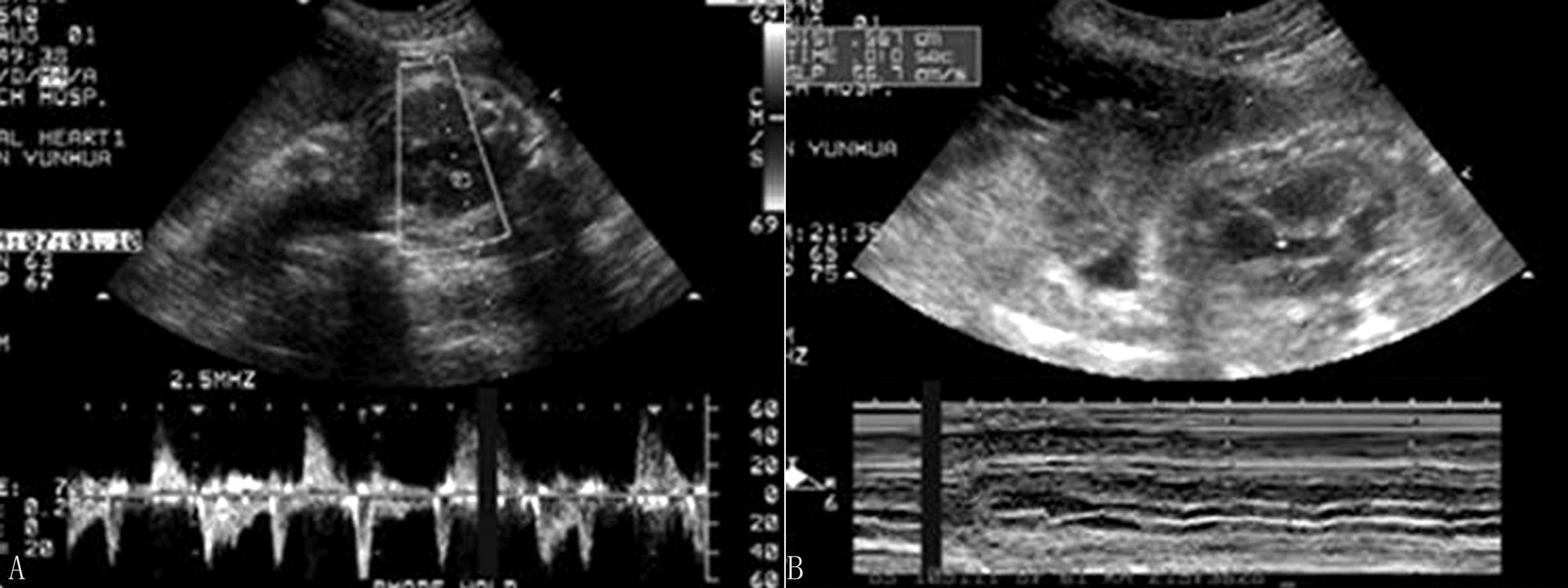 胎儿心电图心跳快是什么原因,胎儿心律不齐超声报告