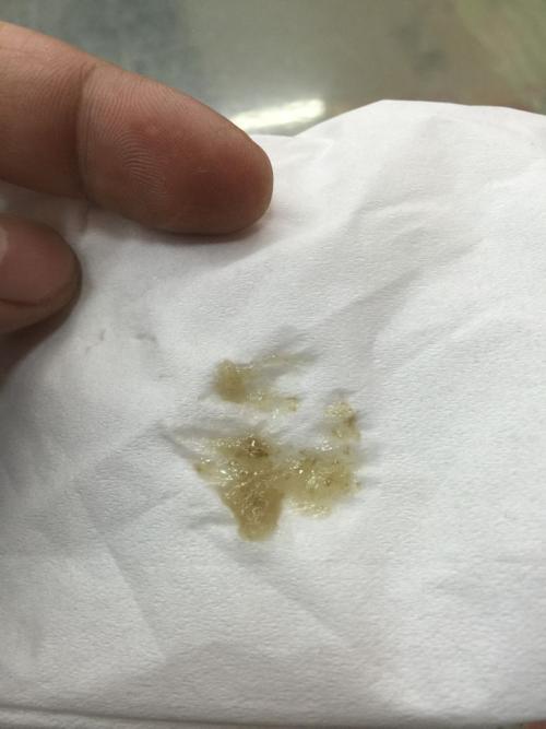 咽喉有痰胸口堵是什么原因,早上起床咽喉有黄痰是什么原因