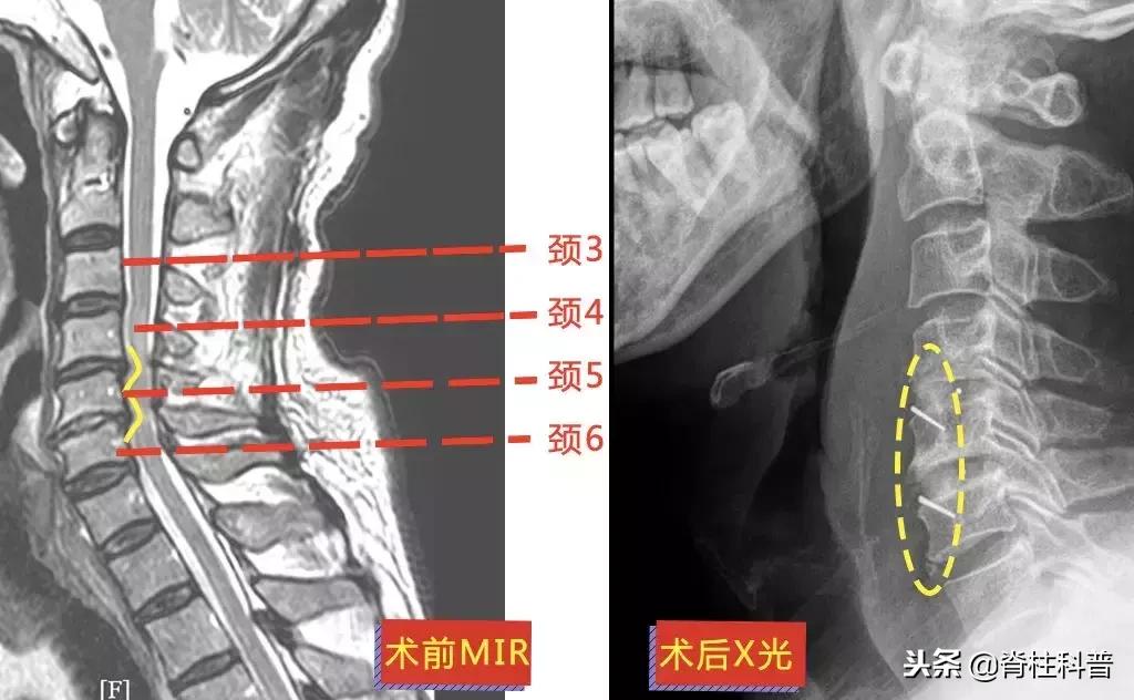 颈椎病治疗的分享,关于颈椎病通俗易懂的科普
