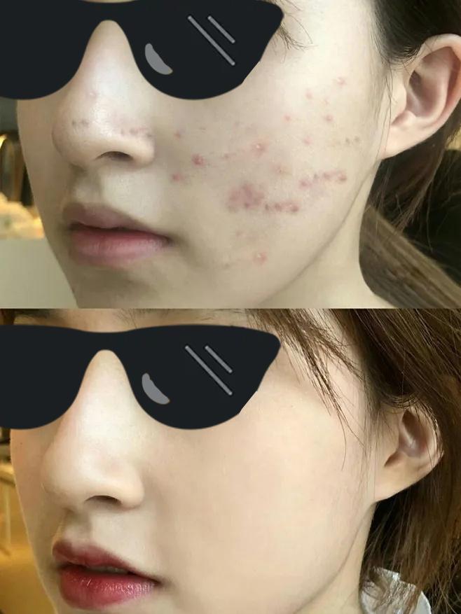 教你4个淡化黑色痘印的有效方法,改善痘印用什么酸效果最好