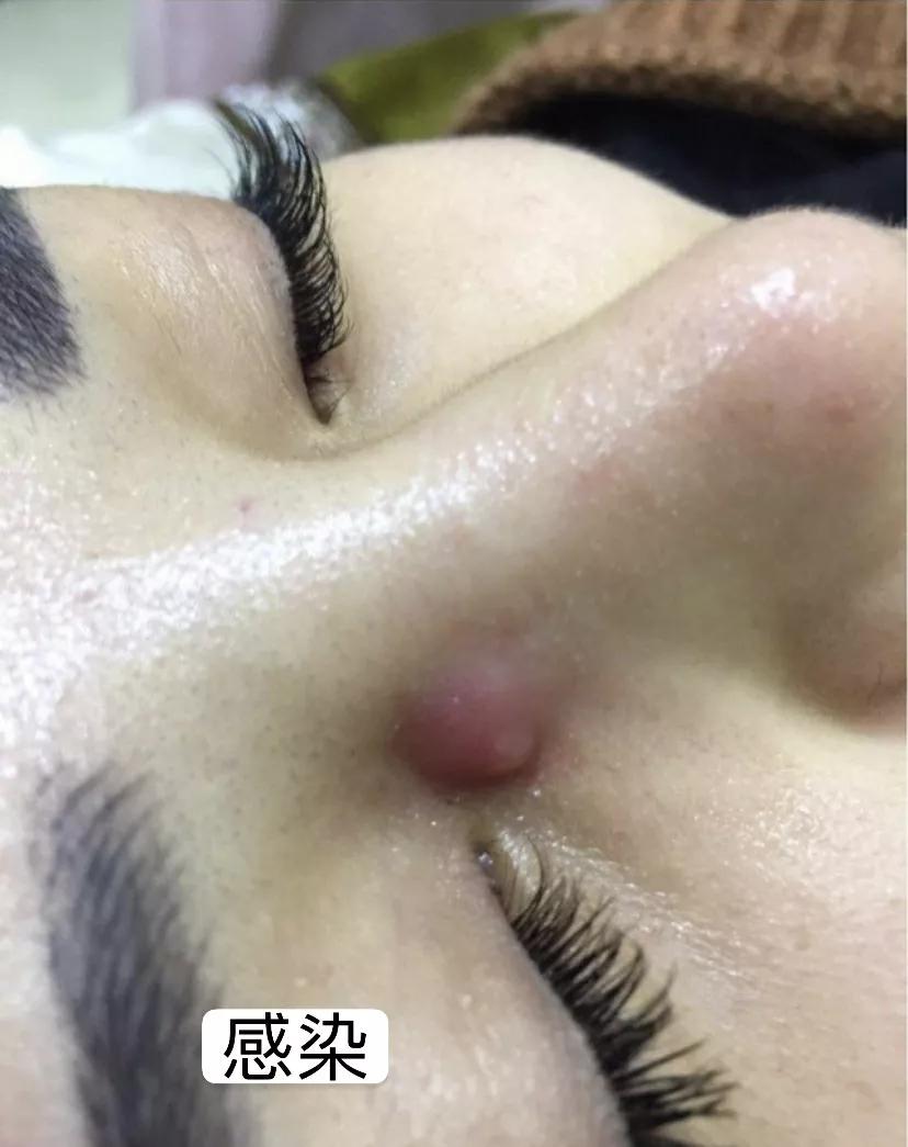 假体隆鼻后5天鼻尖发红,假体隆鼻三年后鼻尖发红