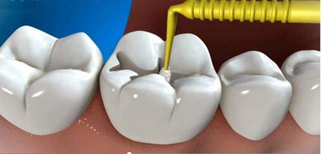 3岁宝宝牙齿蛀牙怎么办,3周岁宝宝蛀牙怎么让他配合