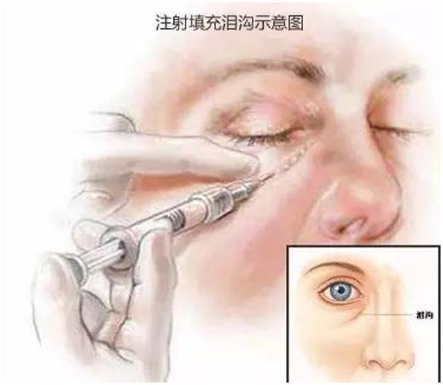 如何让泪沟消失小技巧,泪沟真的毫无办法吗