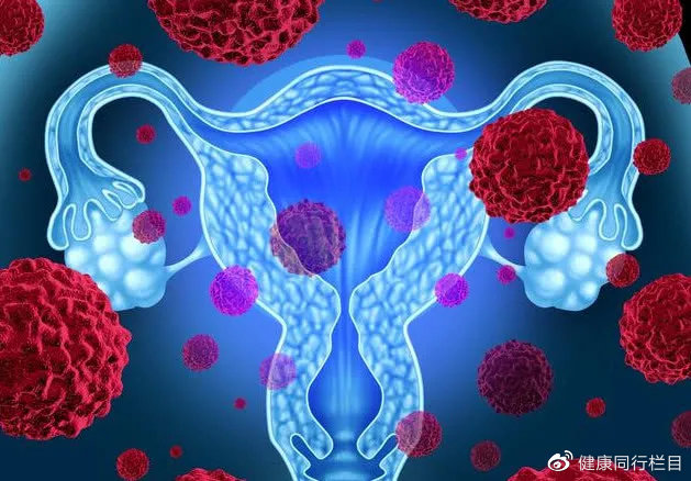 子宫内膜癌的防癌筛查,子宫内膜癌预防与筛查