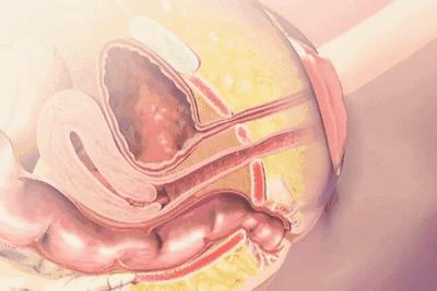 产后盆底康复治疗多少钱,产后漏尿需要做几次盆底康复