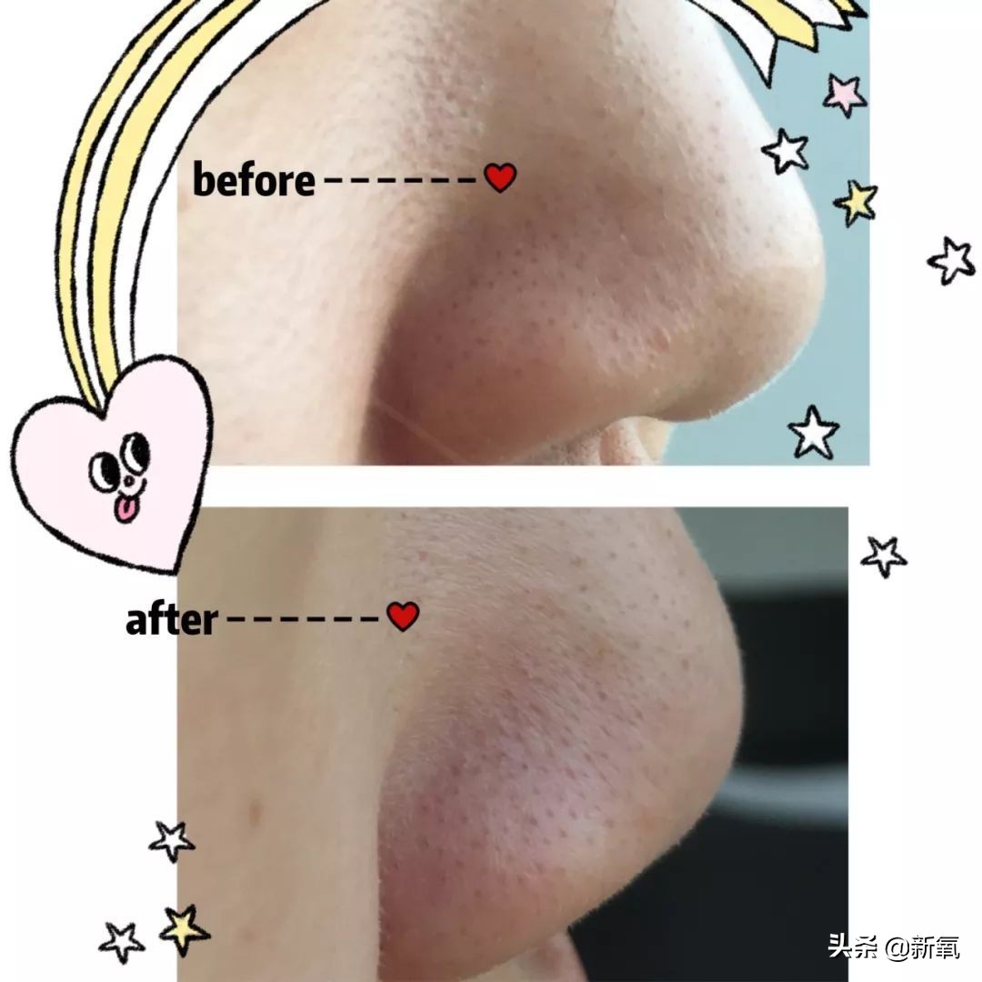 去黑头最有效的方法一个月见效,别挤了教你去黑头的正确方法