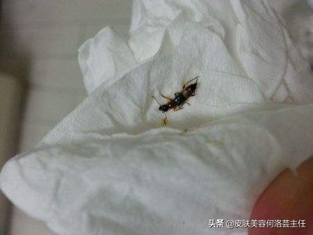 反复出油长痘毛孔堵塞怎么调理,t区出油毛孔大脸颊干是什么肤质