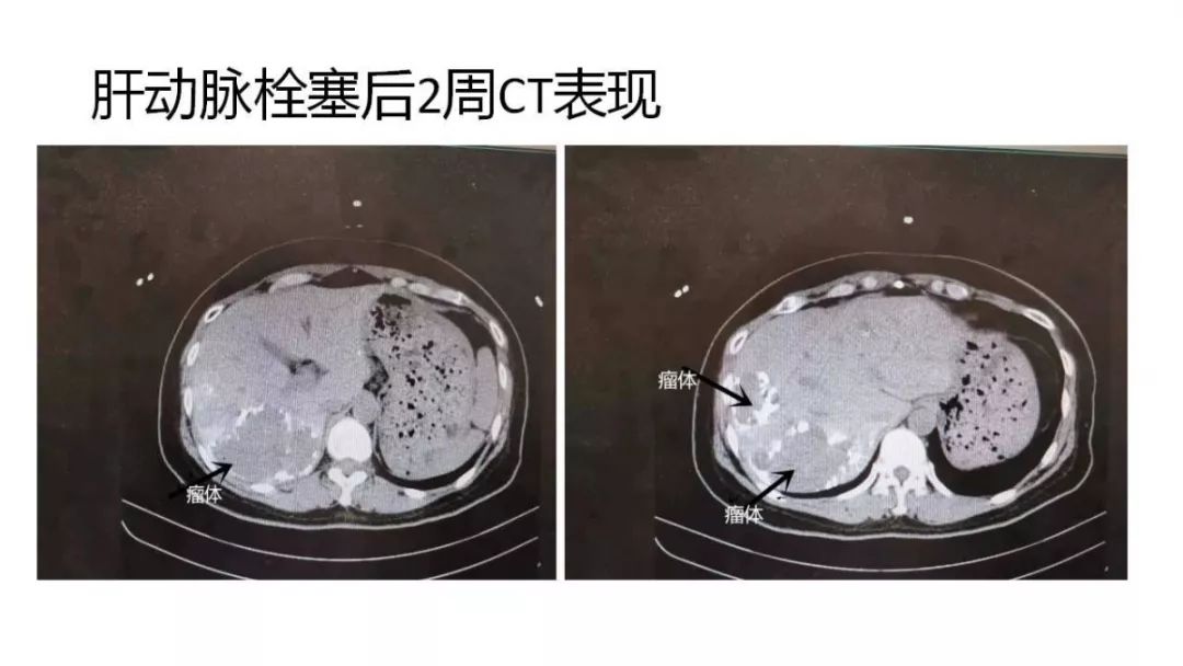 天津肝血管瘤射频消融术,肝血管瘤穿刺射频消融术