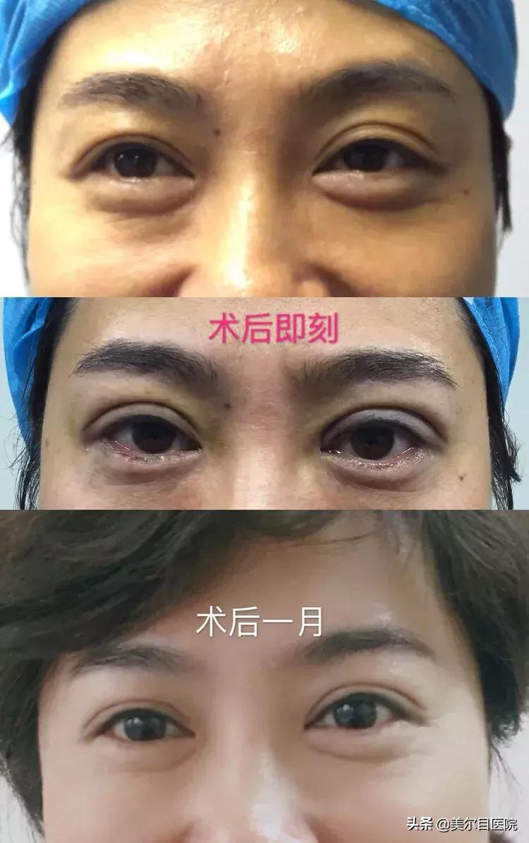 小美美学双眼皮,小美纹绣无痕双眼皮