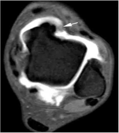 踝关节撞击症问诊,踝关节内侧撞击综合症位置图