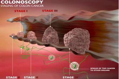 6种最常见癌症的早期症状,六种常见的癌有哪些