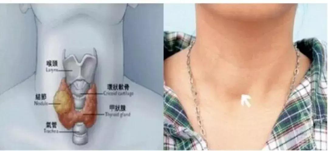 产后暴瘦对身体有害吗,产后抑郁暴瘦