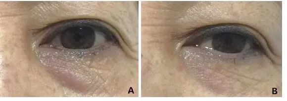 轻医美干细胞填充泪沟真实案例,泪沟明显怎么做医美