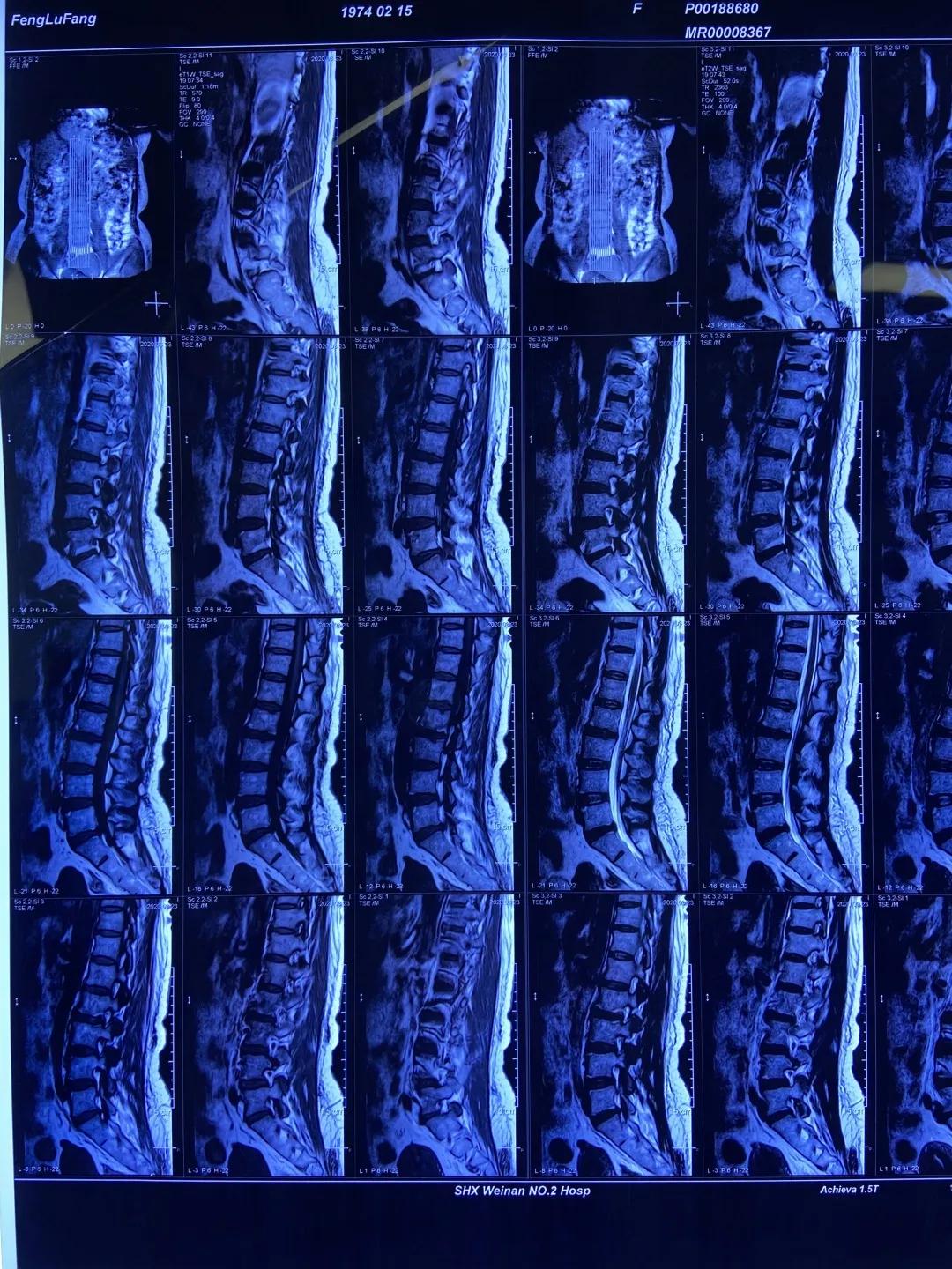 渭南治腰间盘突出哪家最好,脊柱神经外科手术