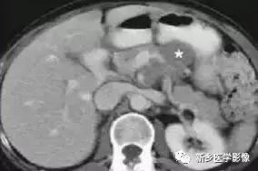 18种胰腺肿瘤，为什么我就知道两种