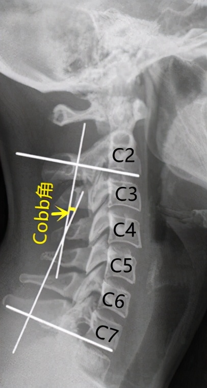 颈椎生理曲度过曲是啥意思,颈椎生理弯曲变直反弓怎么治疗