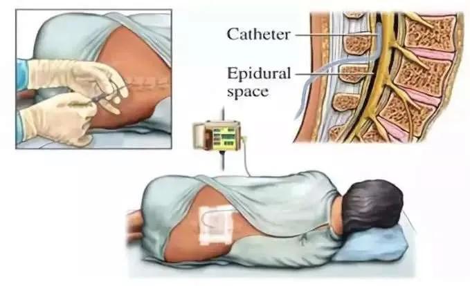 哪个说生娃儿就一定要痛?这些关于分娩镇痛的谣言太坑人!