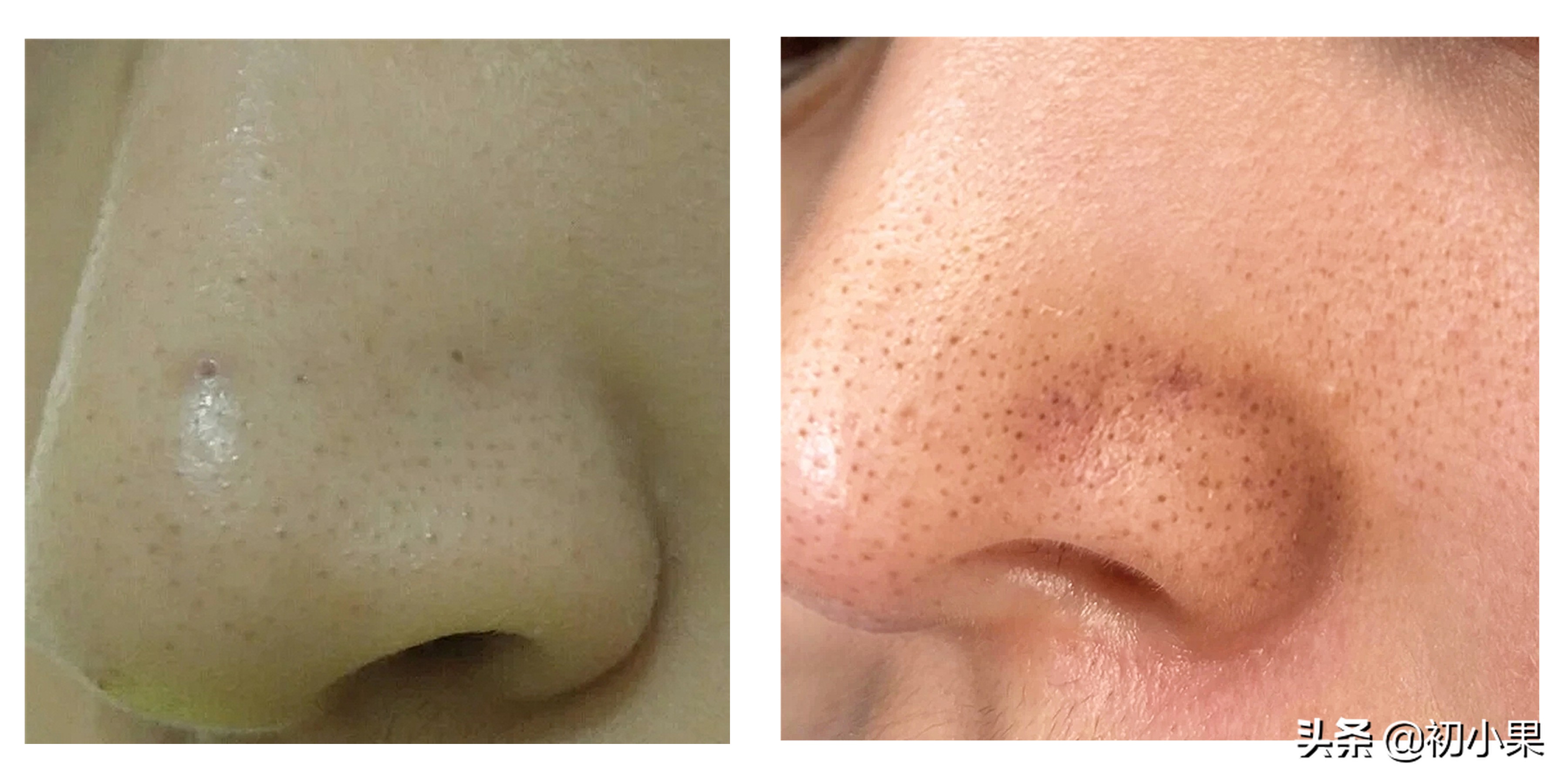 鼻子上的黑头怎么去除,鼻子上的黑头怎么去除小孩