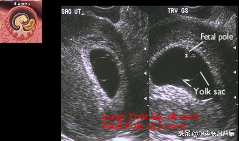 内见卵黄囊,卵黄囊肿瘤