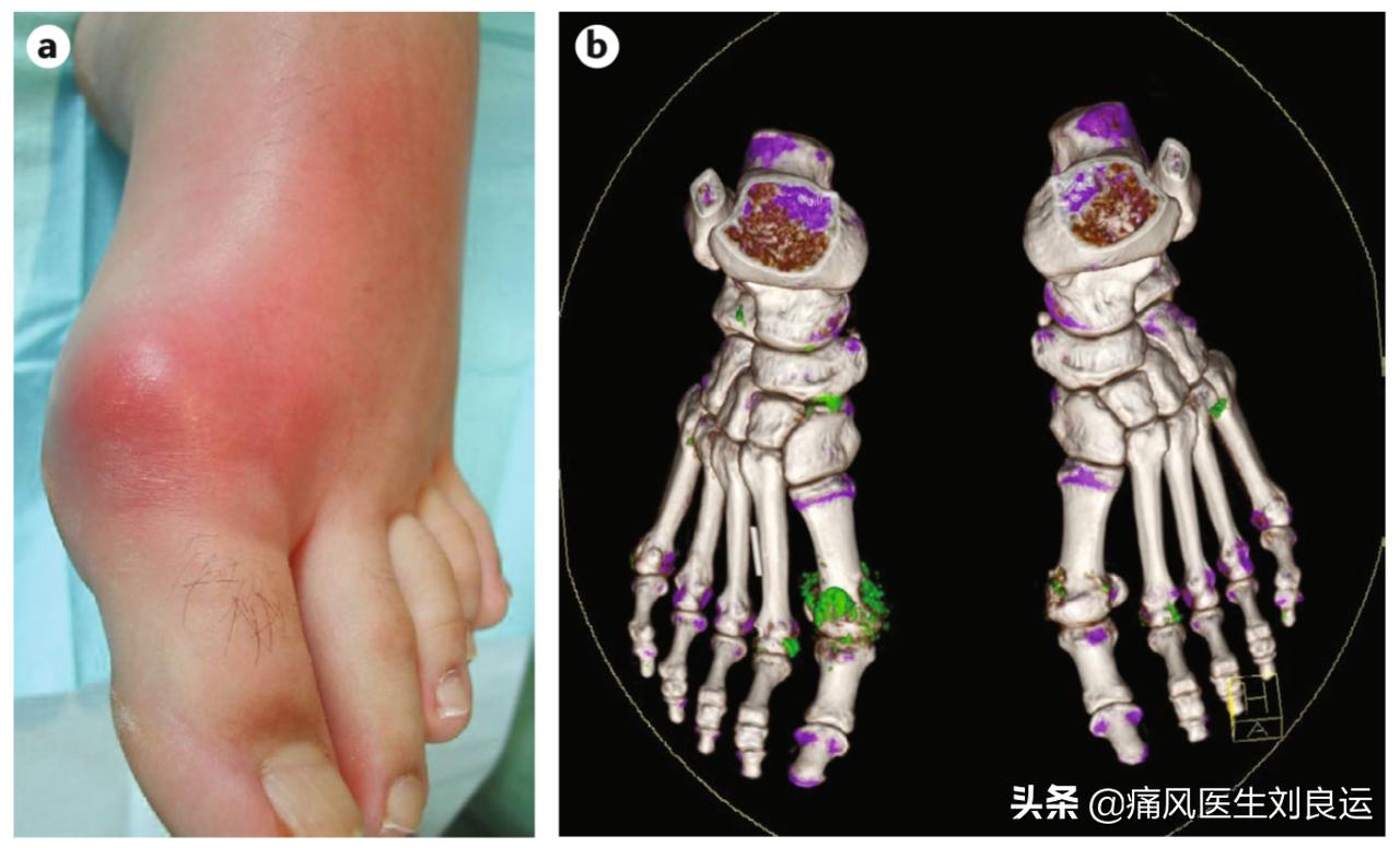 痛风关节炎治疗后如何降尿酸,痛风肾病患者尿酸控制到多少